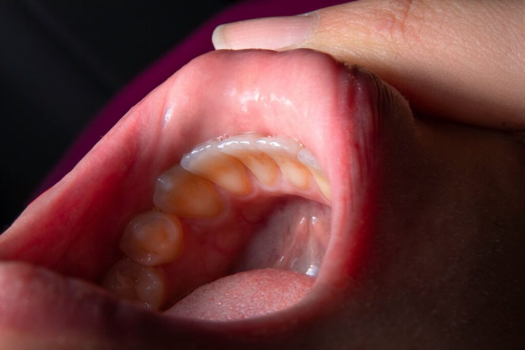 gingivitis